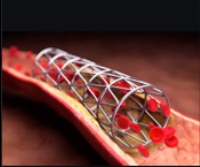 Coronary Stent Coating